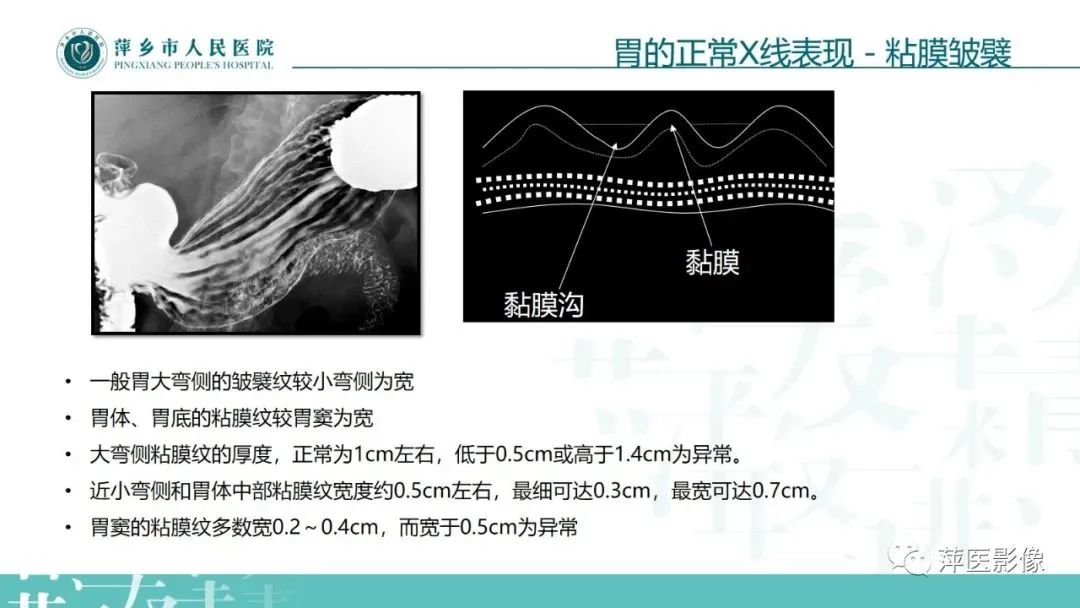 【PPT】腹部X线基础影像-31
