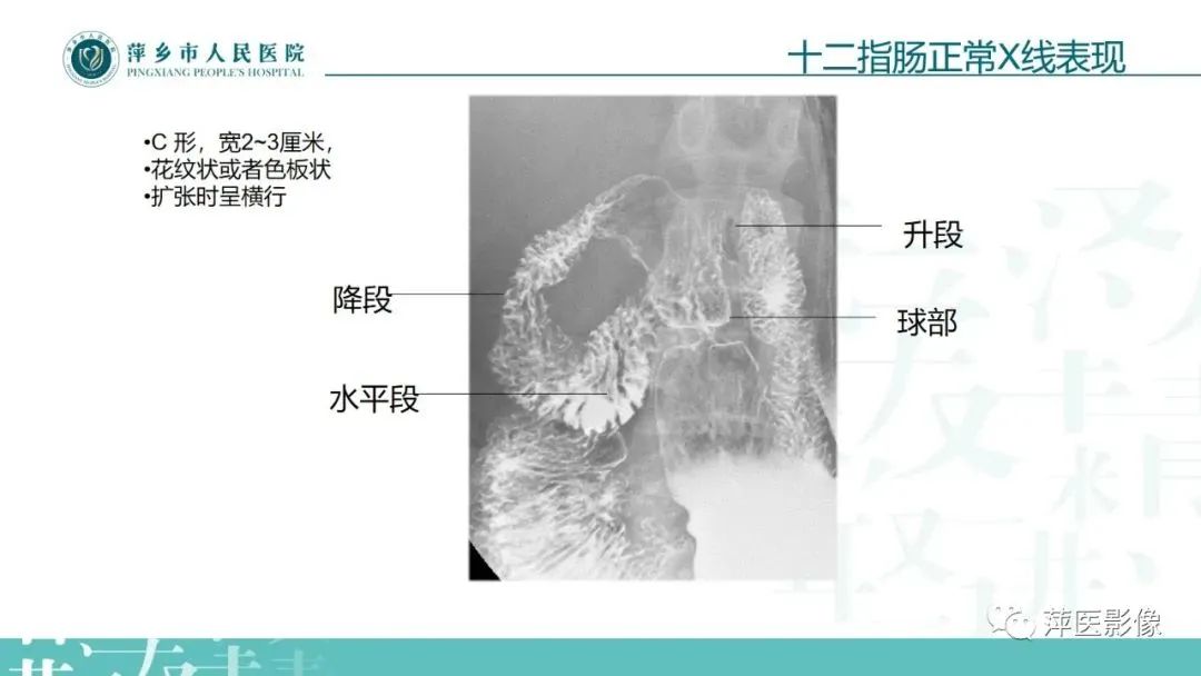 【PPT】腹部X线基础影像-32