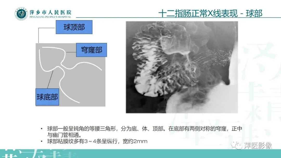 【PPT】腹部X线基础影像-33