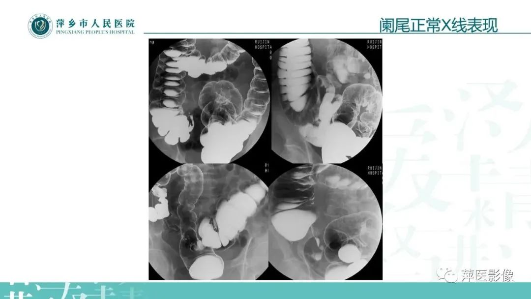 【PPT】腹部X线基础影像-35