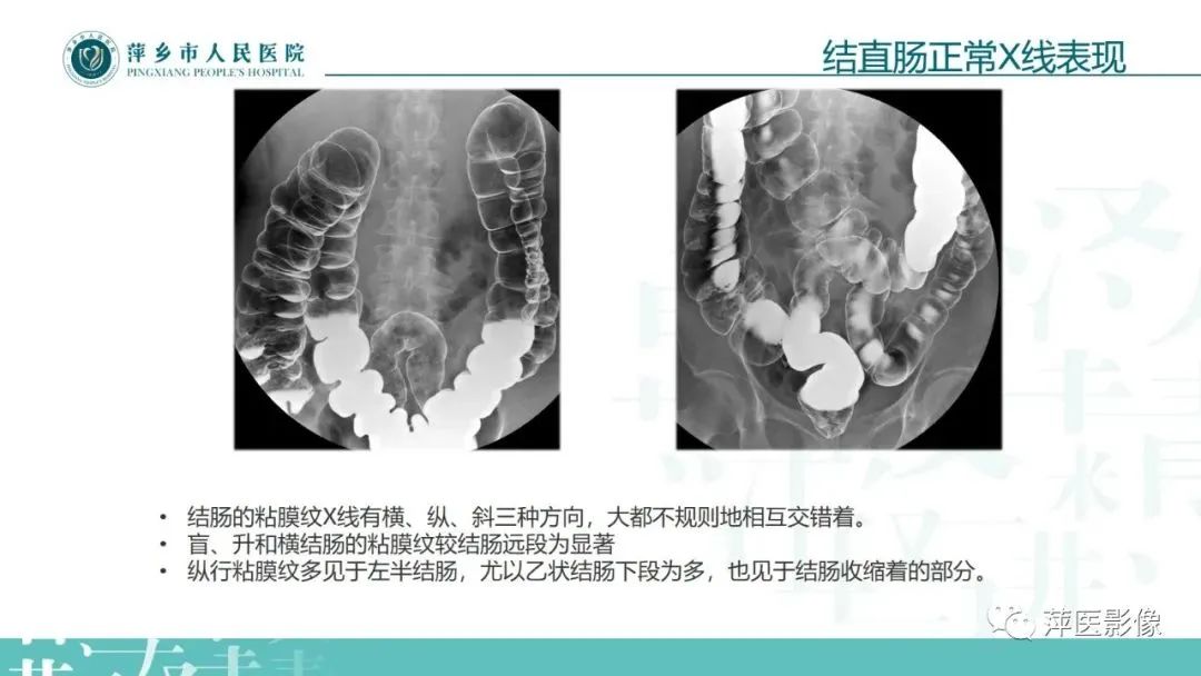 【PPT】腹部X线基础影像-36