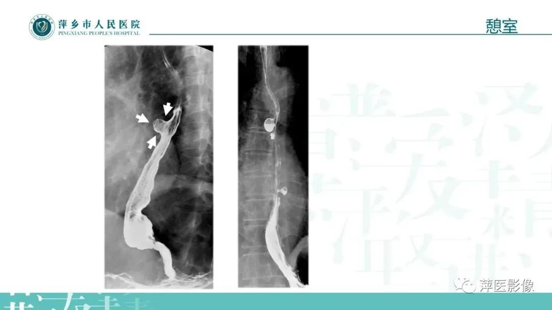 【PPT】腹部X线基础影像-38