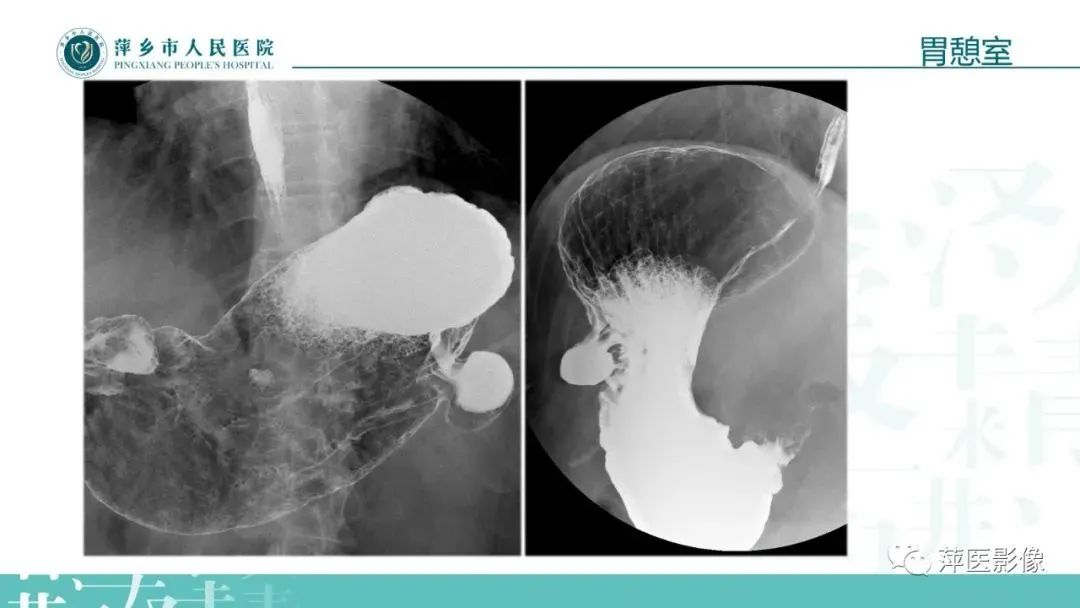 【PPT】腹部X线基础影像-39