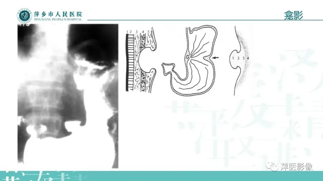 【PPT】腹部X线基础影像-40