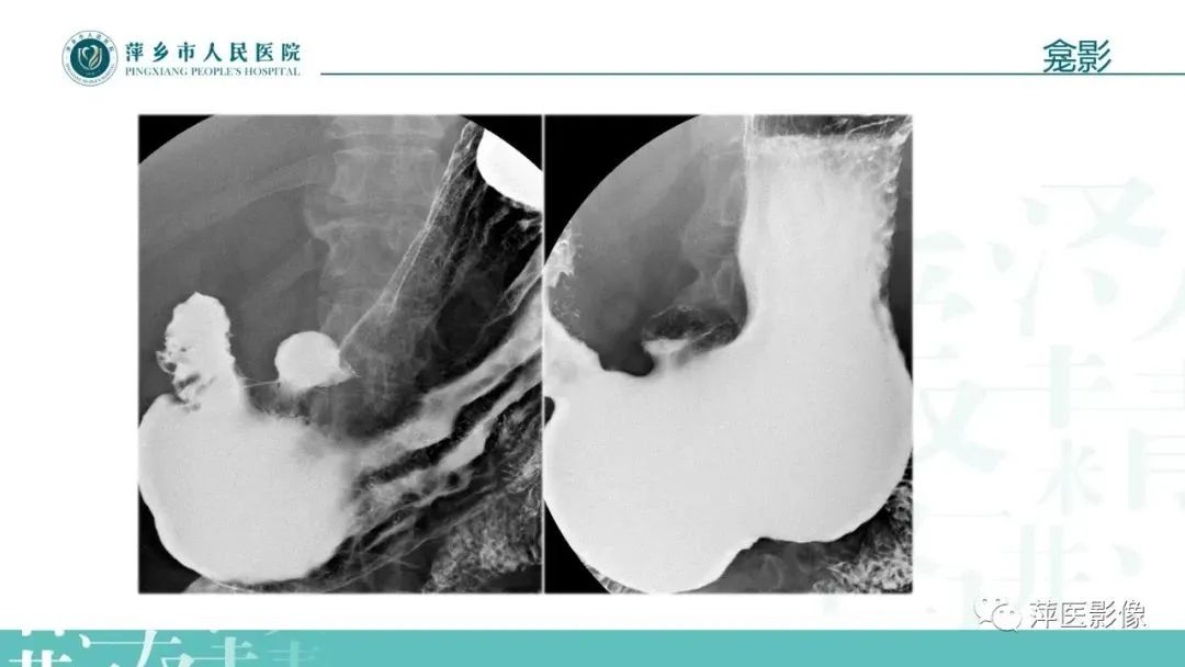 【PPT】腹部X线基础影像-41