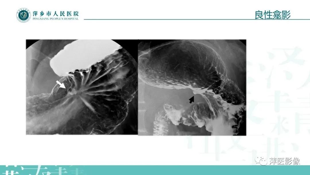 【PPT】腹部X线基础影像-42