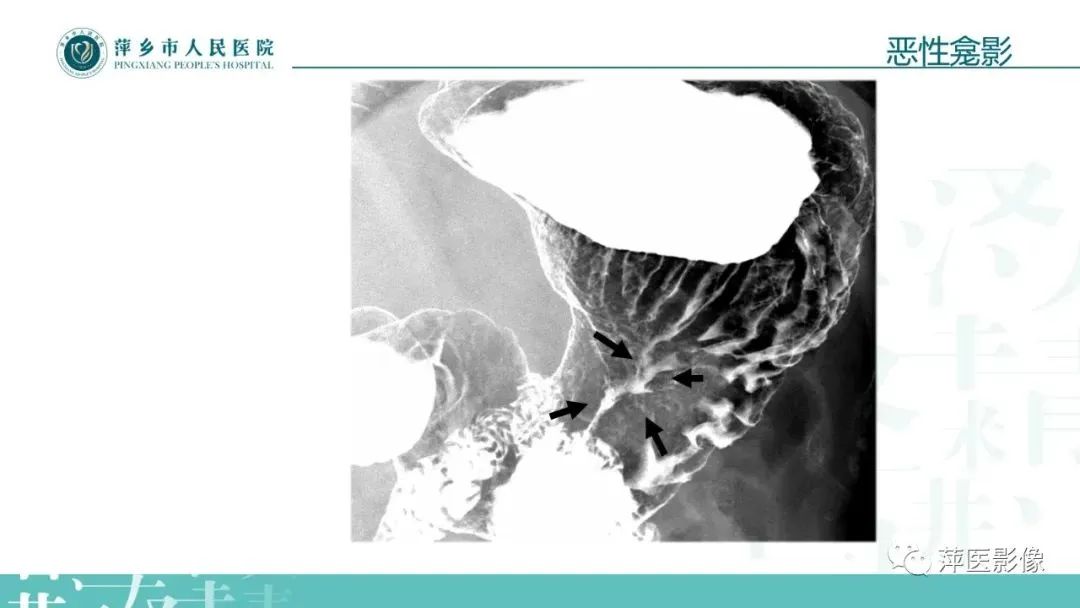 【PPT】腹部X线基础影像-44