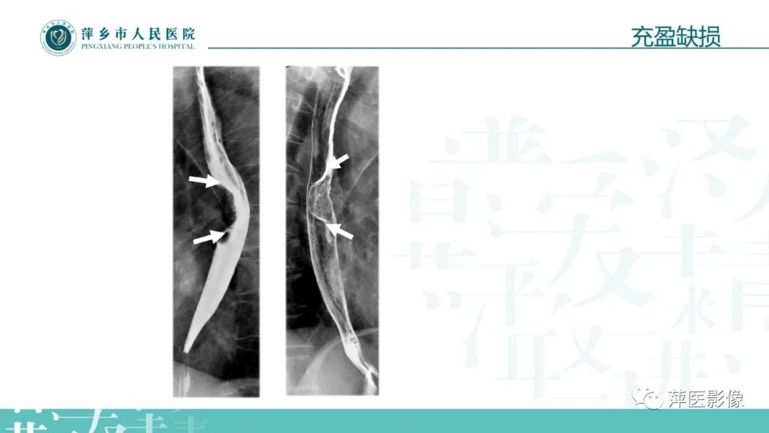 【PPT】腹部X线基础影像-45