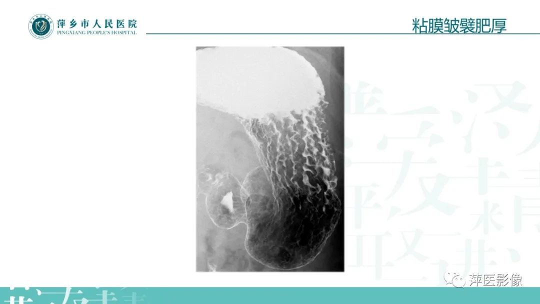 【PPT】腹部X线基础影像-46