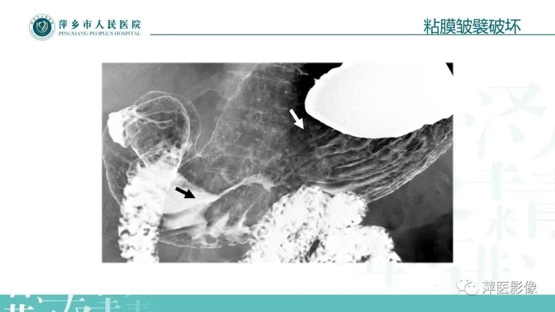 【PPT】腹部X线基础影像-48