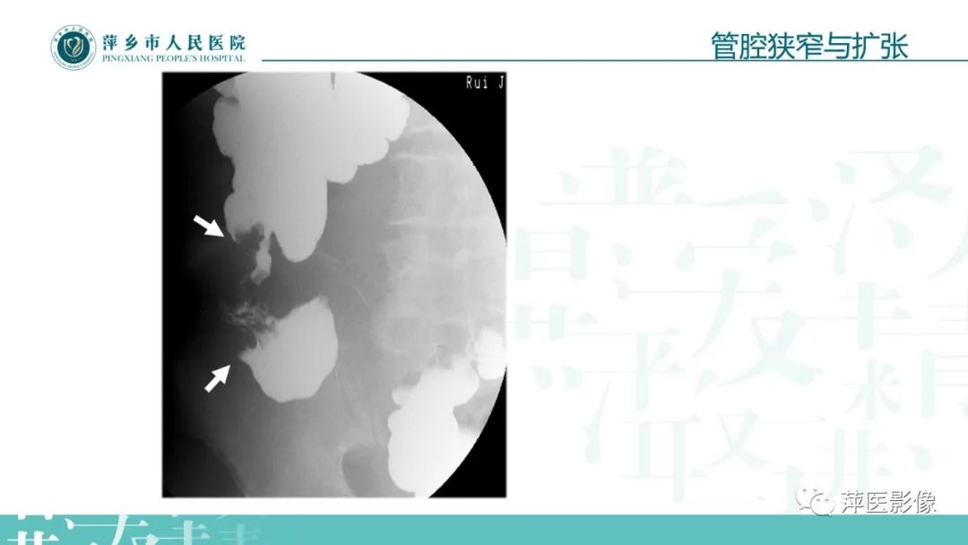 【PPT】腹部X线基础影像-50