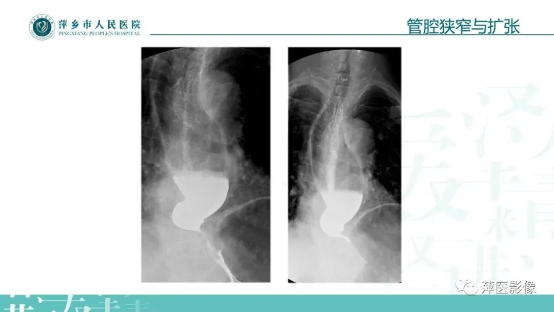 【PPT】腹部X线基础影像-49