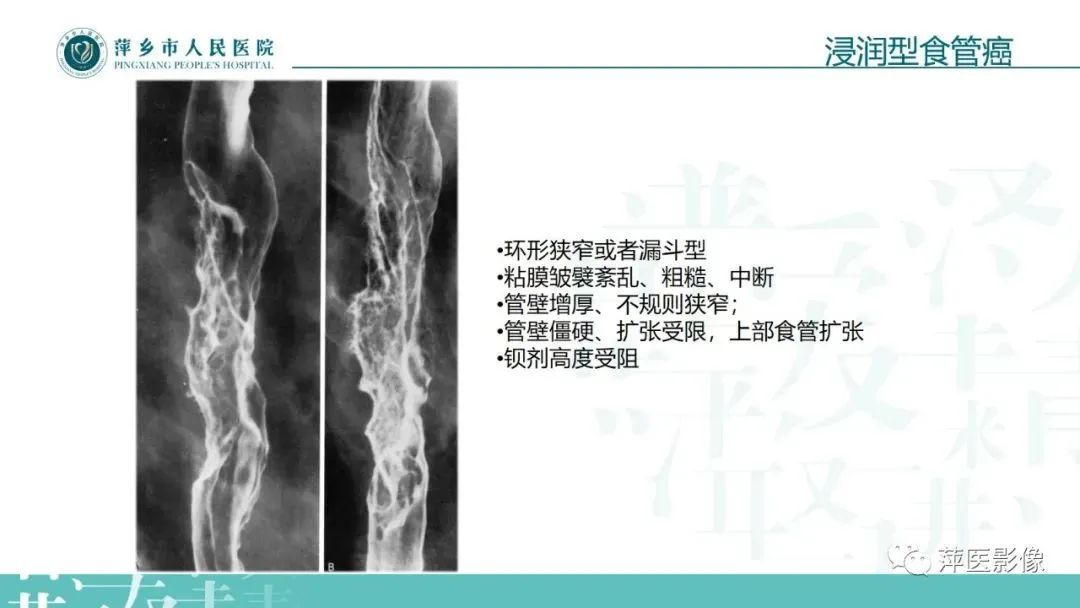 【PPT】腹部X线基础影像-54