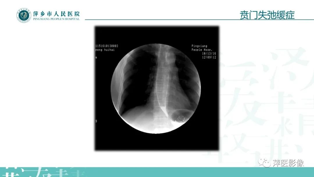 【PPT】腹部X线基础影像-56
