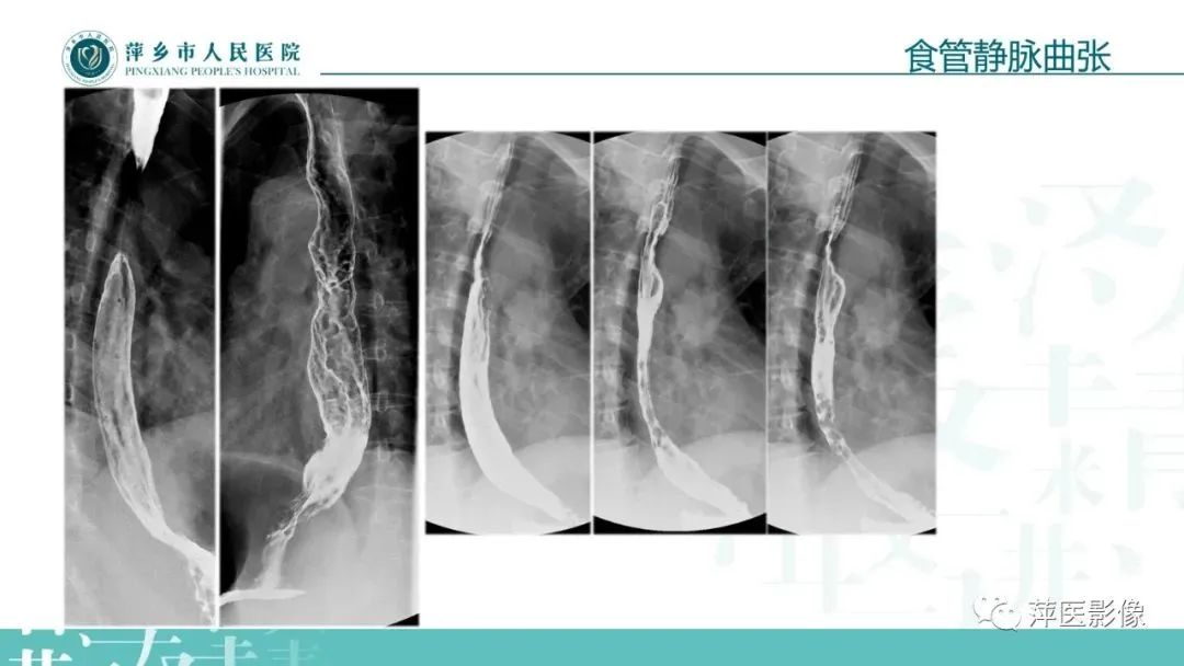 【PPT】腹部X线基础影像-55