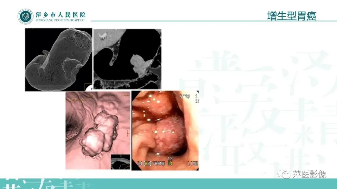 【PPT】腹部X线基础影像-57