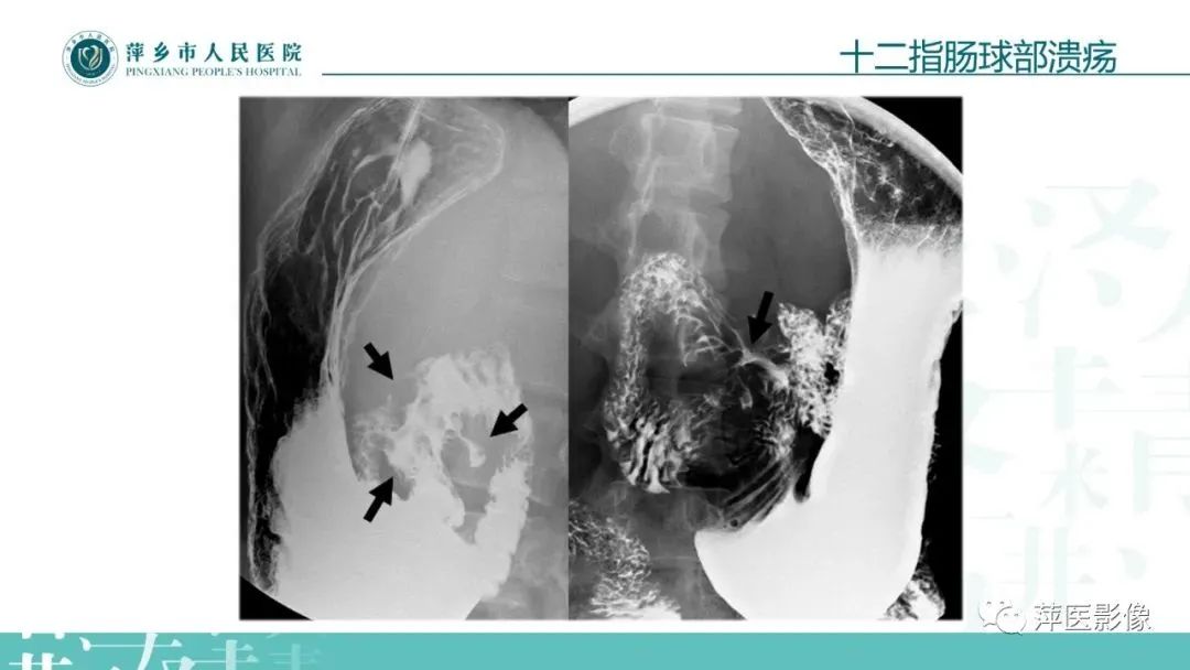 【PPT】腹部X线基础影像-58