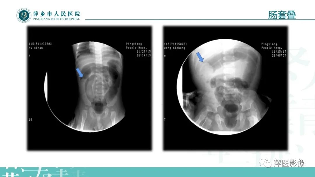 【PPT】腹部X线基础影像-59