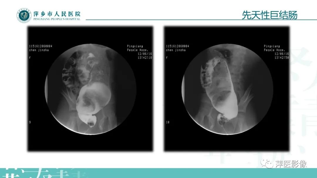 【PPT】腹部X线基础影像-60