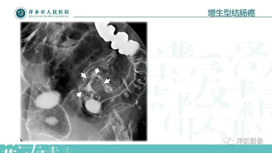 【PPT】腹部X线基础影像-61
