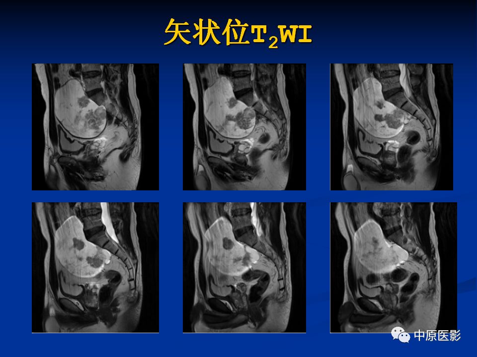 【病例】腹膜后盆腔神经鞘瘤1例MR影像-5