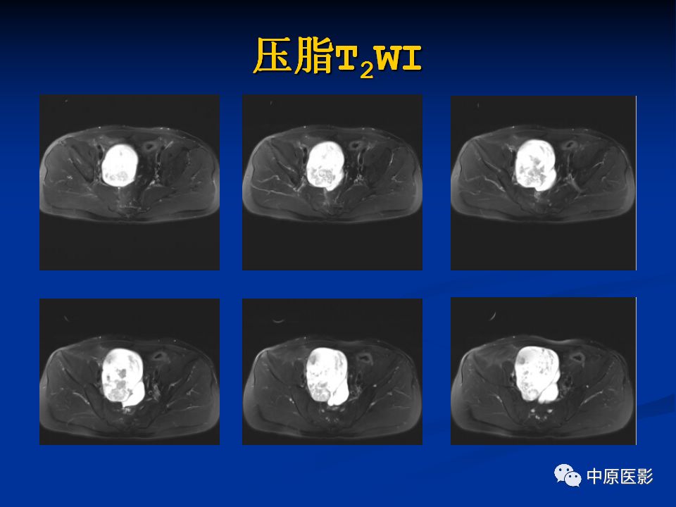 【病例】腹膜后盆腔神经鞘瘤1例MR影像-4