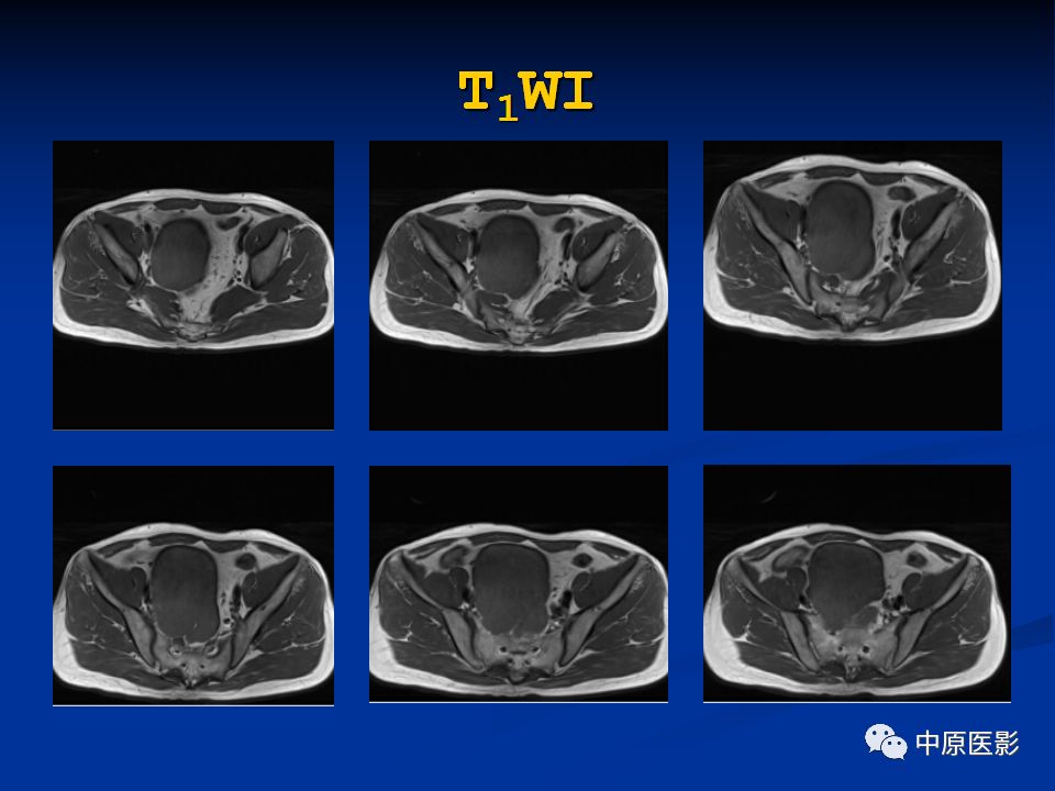 【病例】腹膜后盆腔神经鞘瘤1例MR影像-3