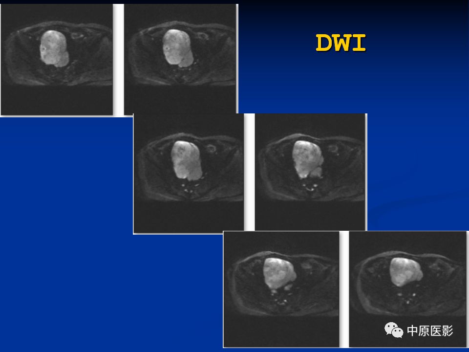 【病例】腹膜后盆腔神经鞘瘤1例MR影像-7