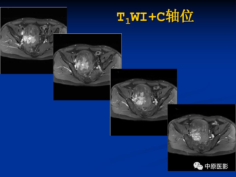 【病例】腹膜后盆腔神经鞘瘤1例MR影像-9