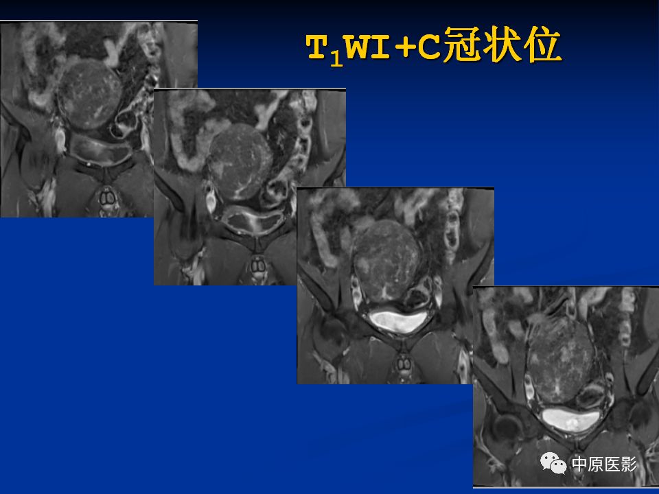 【病例】腹膜后盆腔神经鞘瘤1例MR影像-10