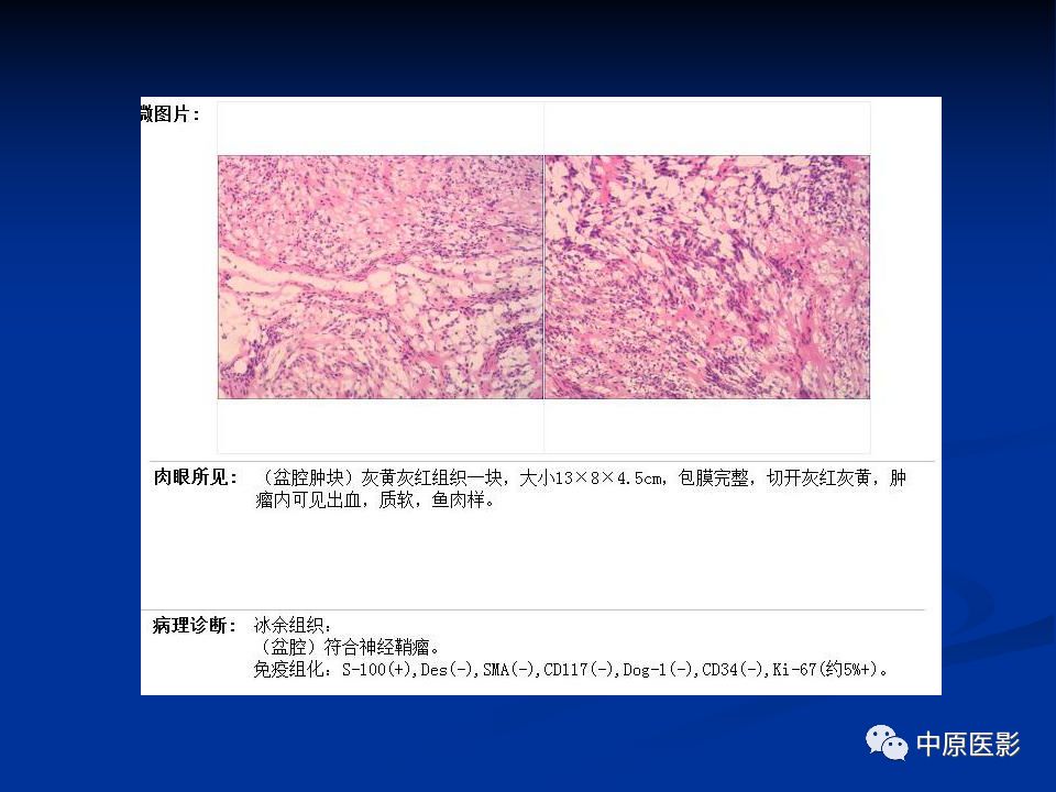 【病例】腹膜后盆腔神经鞘瘤1例MR影像-14