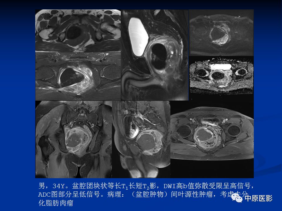 【病例】腹膜后盆腔神经鞘瘤1例MR影像-23