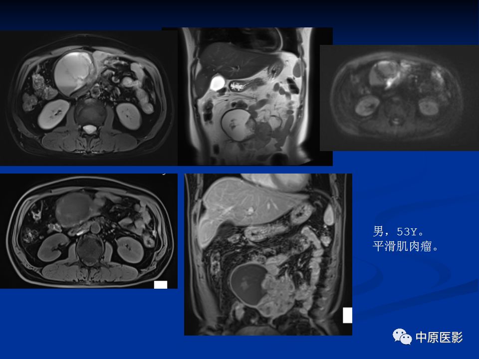 【病例】腹膜后盆腔神经鞘瘤1例MR影像-26