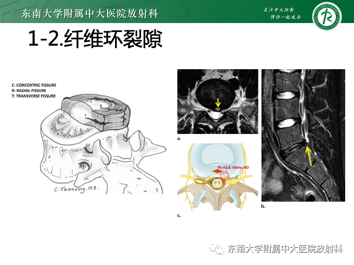 【PPT】下腰痛相关疾病的影像表现-8