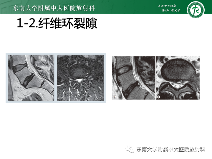 【PPT】下腰痛相关疾病的影像表现-9