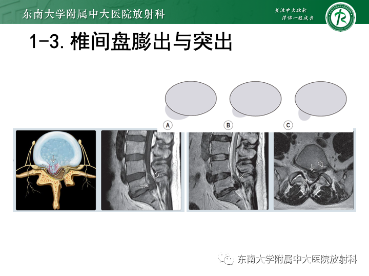 【PPT】下腰痛相关疾病的影像表现-11