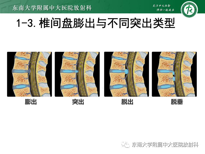 【PPT】下腰痛相关疾病的影像表现-12