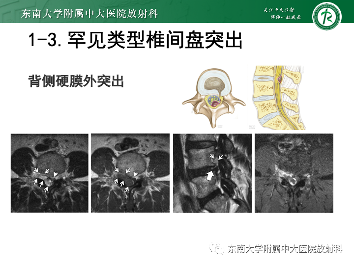 【PPT】下腰痛相关疾病的影像表现-13