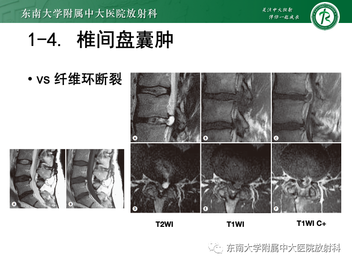 【PPT】下腰痛相关疾病的影像表现-17