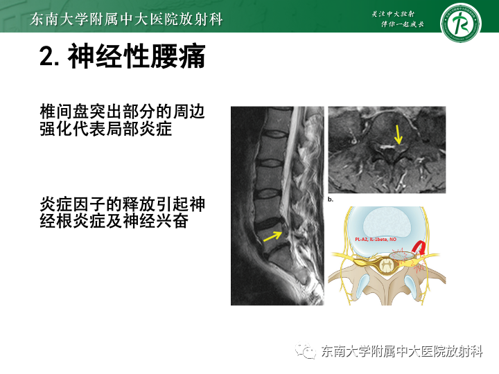 【PPT】下腰痛相关疾病的影像表现-19