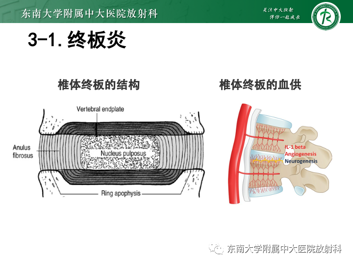 【PPT】下腰痛相关疾病的影像表现-23