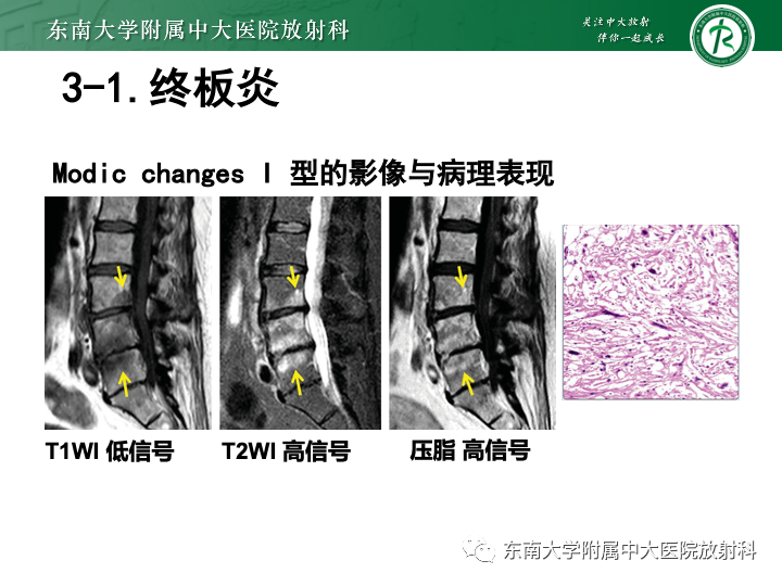 【PPT】下腰痛相关疾病的影像表现-29