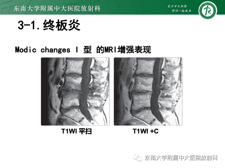 【PPT】下腰痛相关疾病的影像表现-30