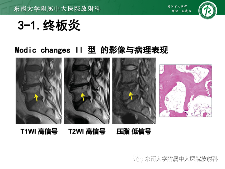 【PPT】下腰痛相关疾病的影像表现-31