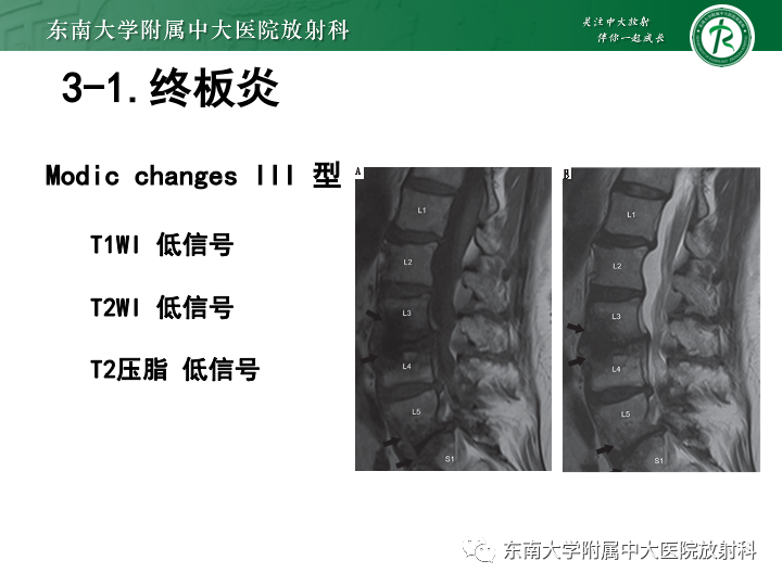 【PPT】下腰痛相关疾病的影像表现-32