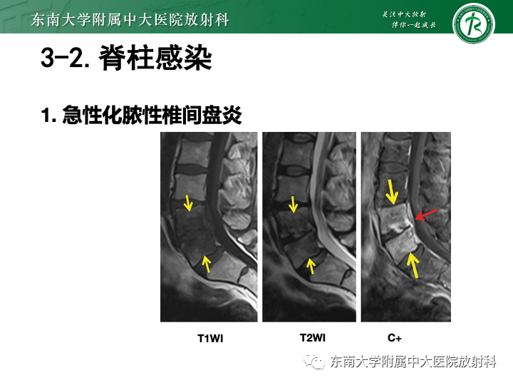 【PPT】下腰痛相关疾病的影像表现-36