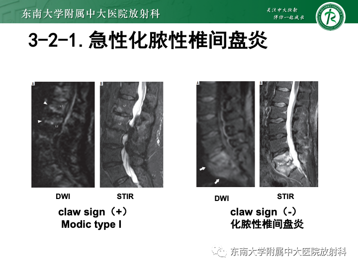 【PPT】下腰痛相关疾病的影像表现-37