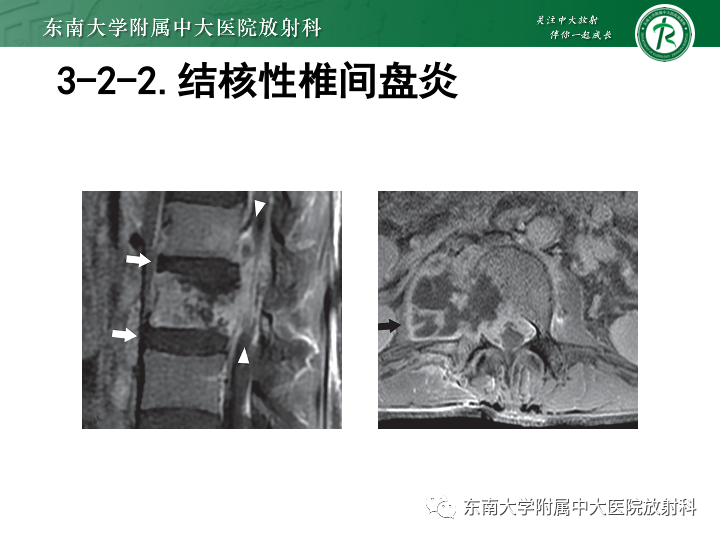 【PPT】下腰痛相关疾病的影像表现-38