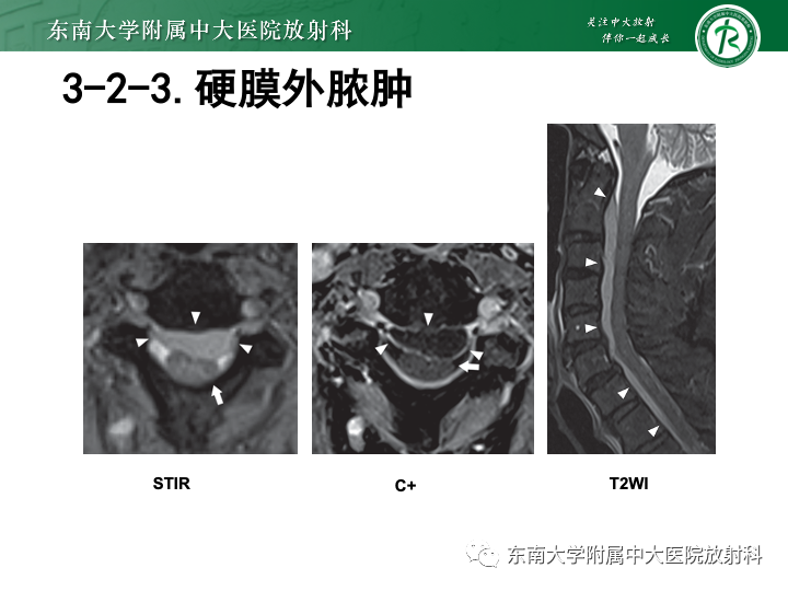 【PPT】下腰痛相关疾病的影像表现-39