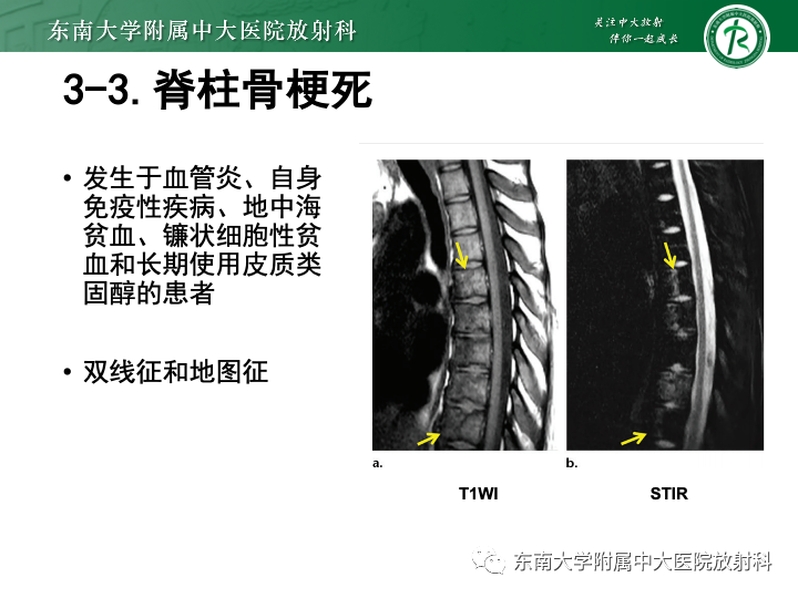 【PPT】下腰痛相关疾病的影像表现-41